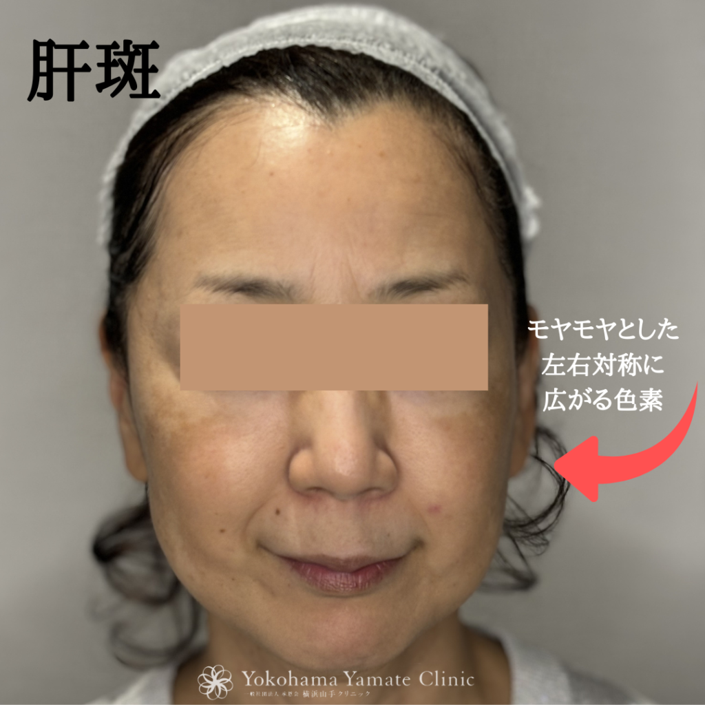 横浜　肝斑治療　肝斑