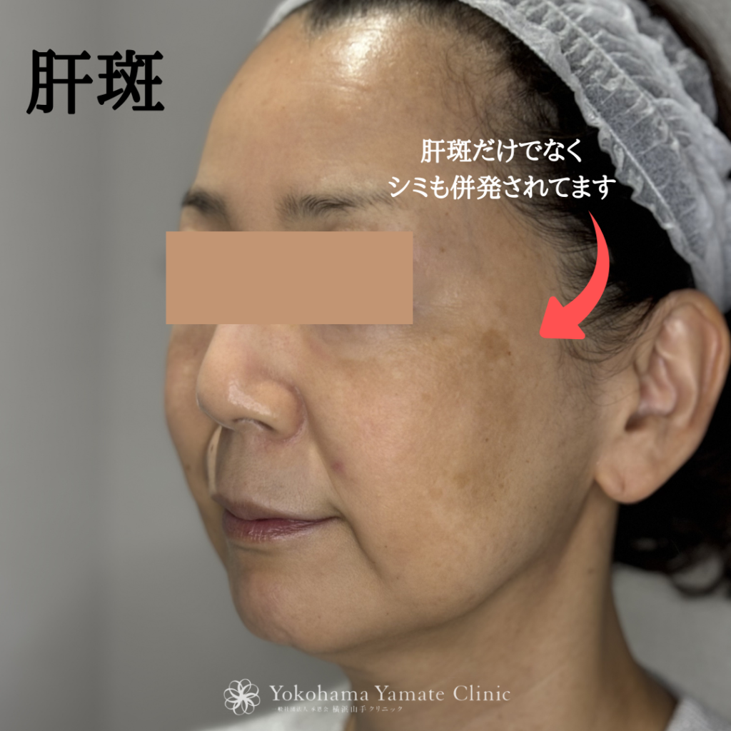 横浜　肝斑治療　肝斑