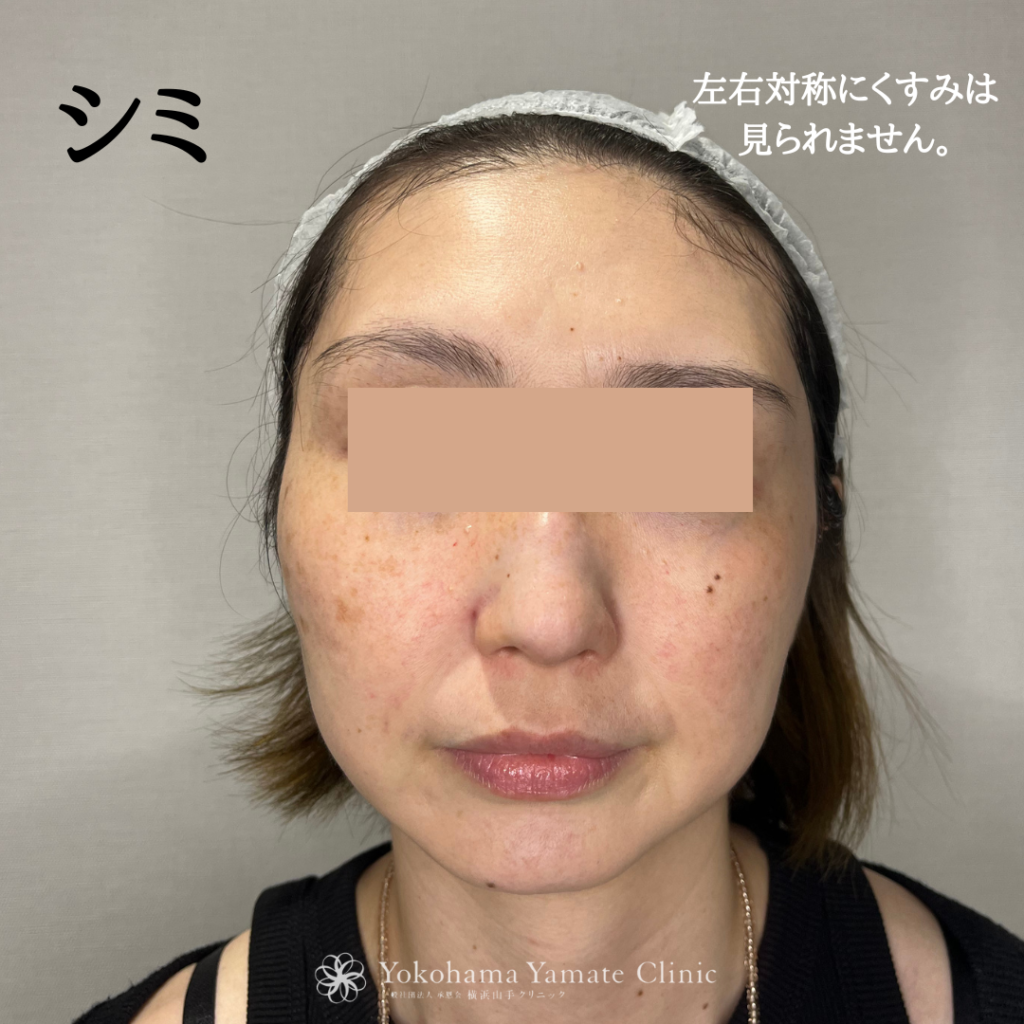 横浜山手　シミ治療　老人性色素斑