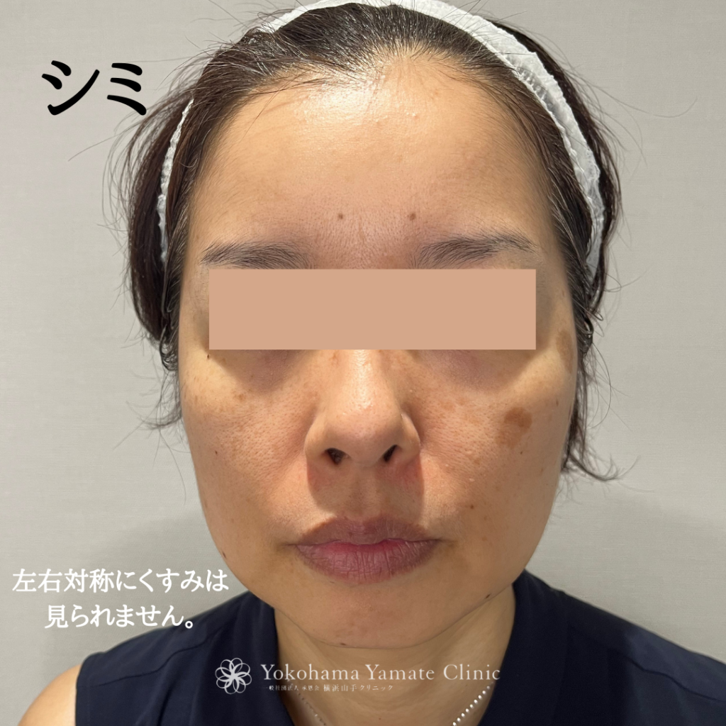 横浜山手　シミ治療　老人性色素斑